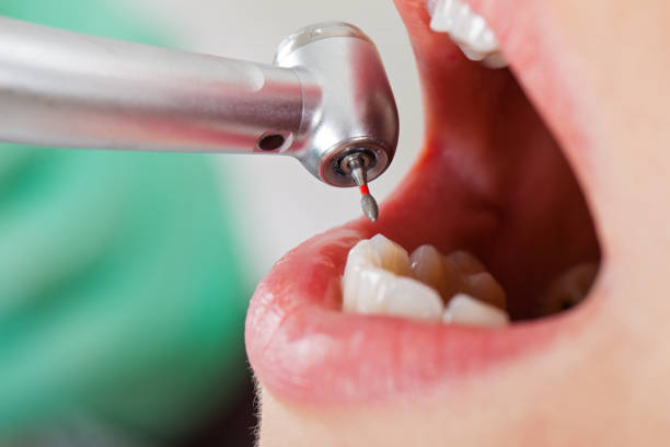 Best Emergency Broken Tooth Repair in Henderson, LA